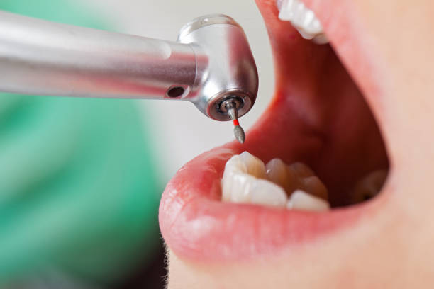 Best Emergency Dentist for Knocked-Out Tooth in St Hedwig, TX